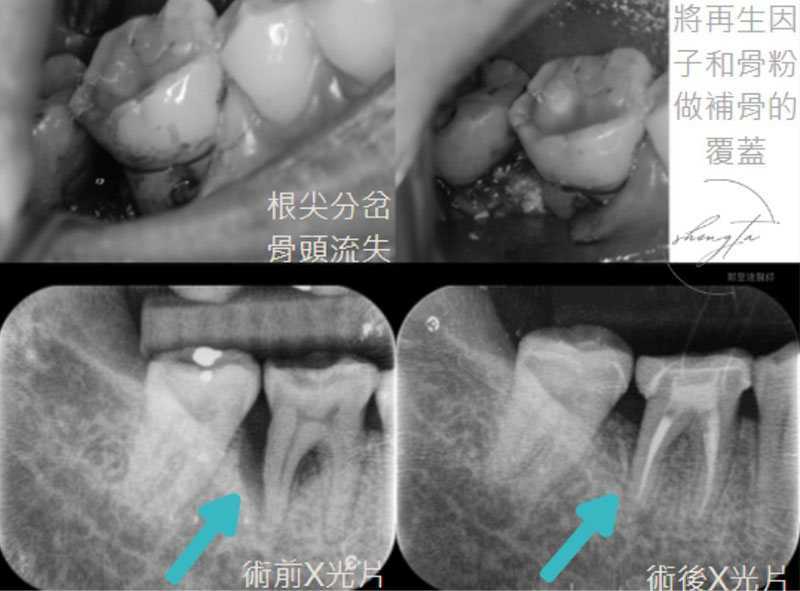 完成牙周再生手術補骨，右下區域治療前後對比，術前根尖分岔處骨頭流失，術後齒槽骨成功再生