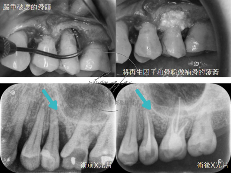 完成牙周再生手術補骨及根管治療，左上區域治療前後對比，可見齒槽骨再生