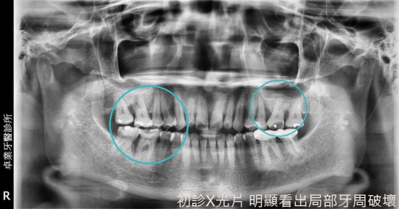 牙周病治療前環口X光片，部分齒槽骨破壞嚴重