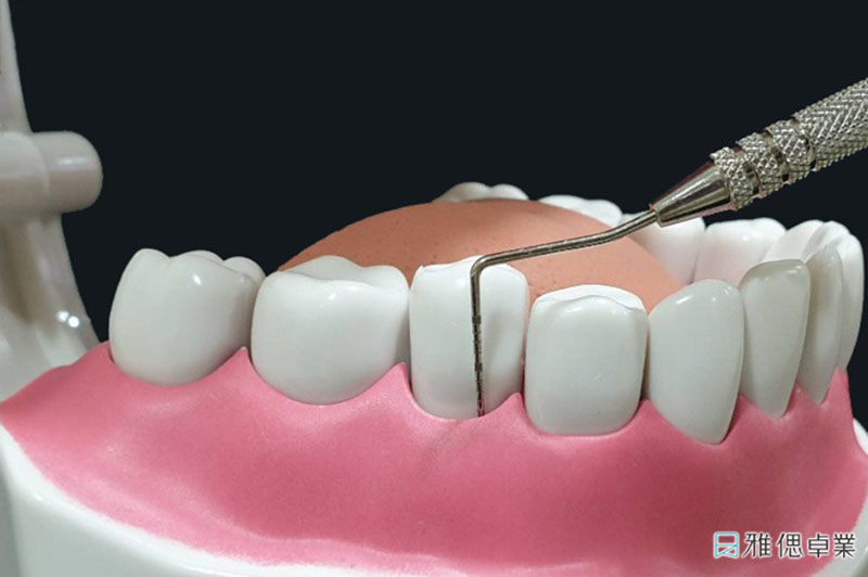使用牙周探針檢測牙周囊袋深度示意圖