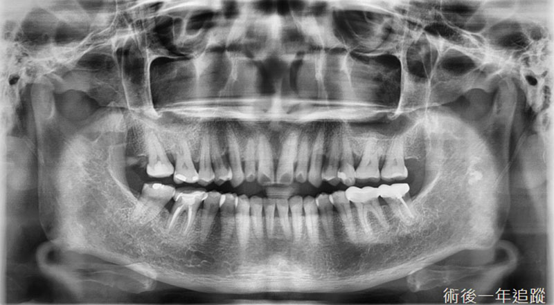 完成水雷射治療與牙周再生手術，術後一年追蹤的環口X光片