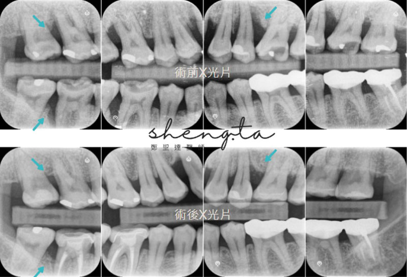 水雷射牙周治療、牙周再生手術前後根尖X光片對比，顯示齒槽骨成功再生
