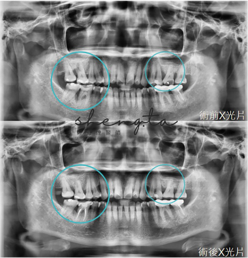 水雷射牙周治療、牙周再生手術前後環口X光片對比，顯示齒槽骨成功再生