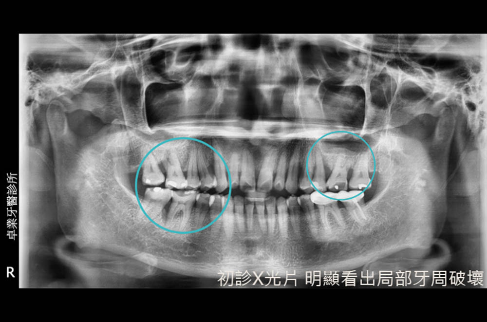 牙周病治療-水雷射-牙周再生手術-補骨-台北牙周病-推薦-鄭聖達醫師
