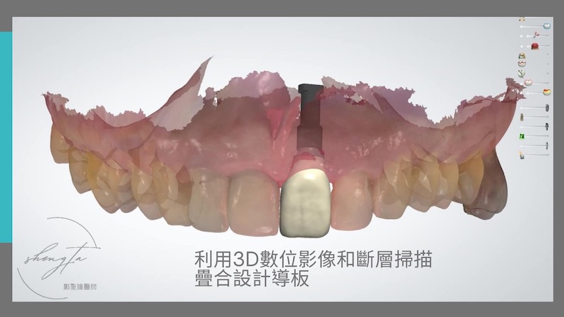 3D影像疊合斷層掃描設計植牙導板）