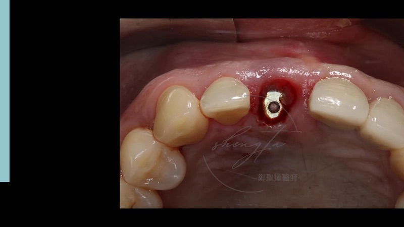 在植牙導板輔助下植入植體，達到很好的植牙位置，傷口也很小
