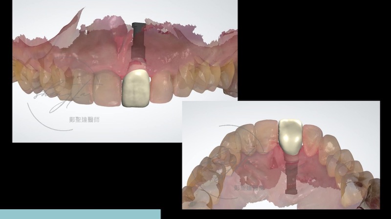 手術完立即運用數位口掃進行假牙設計