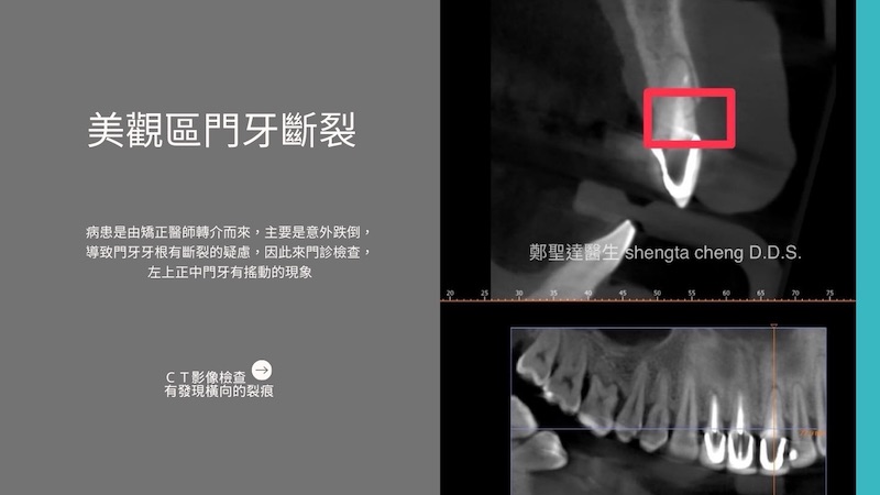 門牙斷裂CT影像，有發現橫向的裂痕