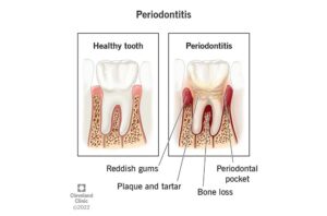 嚴重牙周病-嚴重牙周病治療-過程-台北牙周病-推薦-鄭聖達醫師