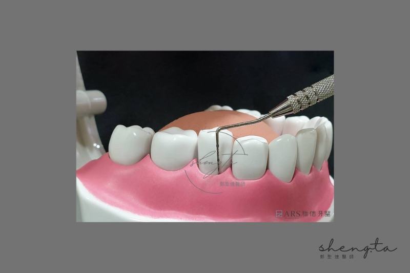 使用牙周探針進行牙周囊袋檢測示意圖，牙周囊袋超過5毫米即為嚴重牙周病