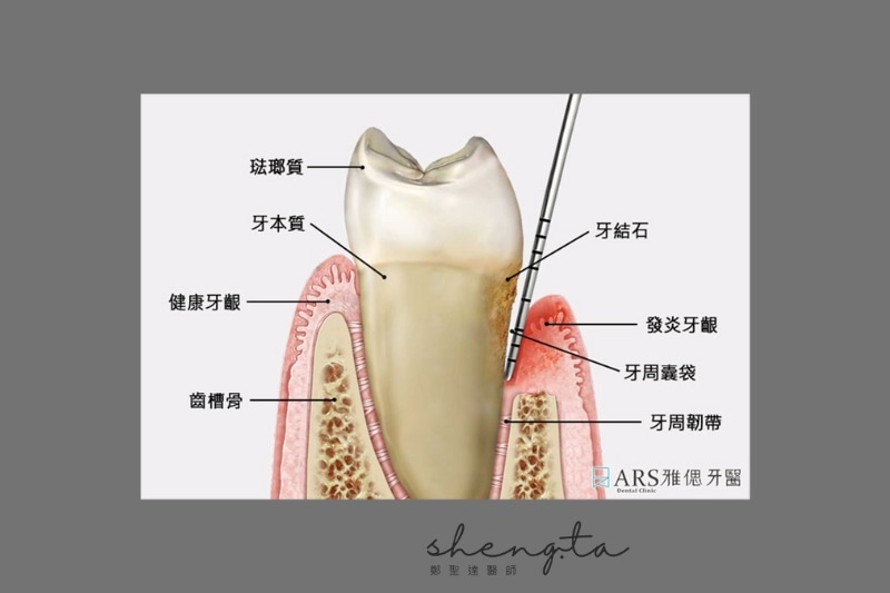 牙周病牙齒、牙周囊袋示意圖