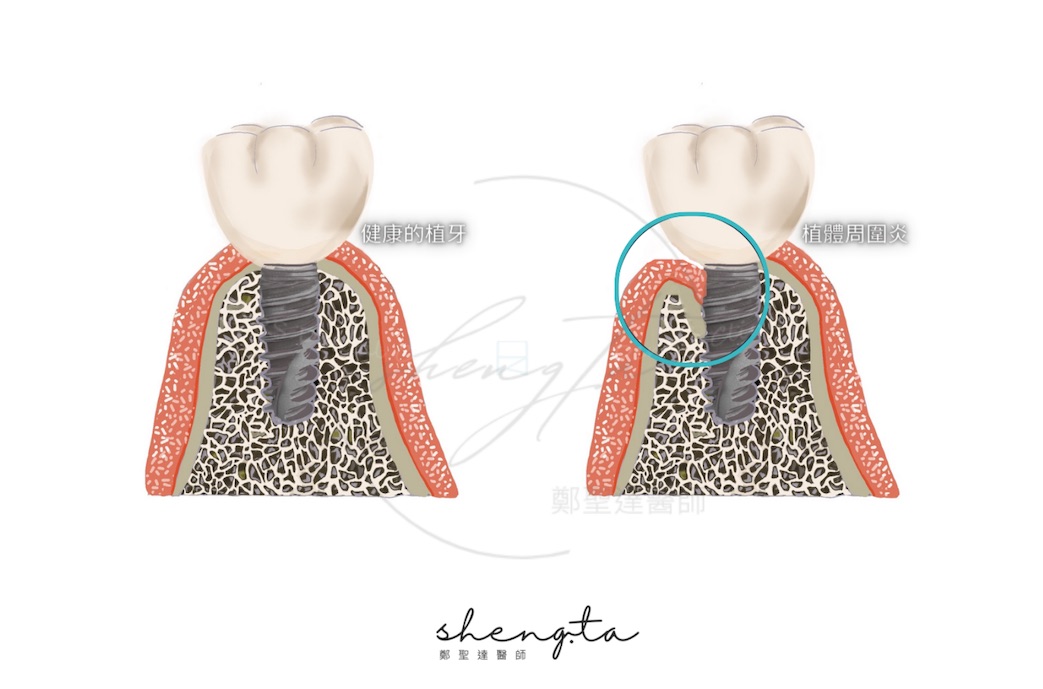 健康植牙與植體周圍炎比較示意圖