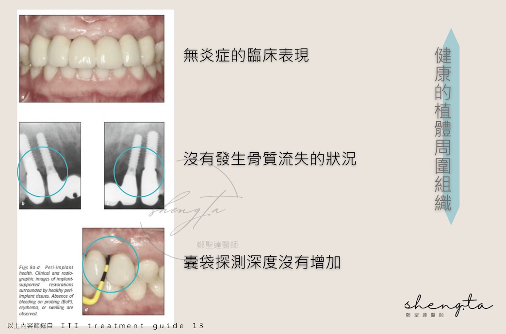 健康的植體周圍組織狀態：無炎症表現與骨質流失狀況，囊袋探測深度沒有增加