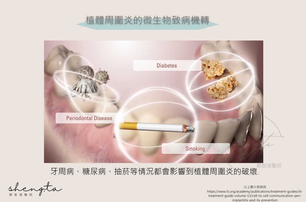 植體周圍炎的微生物致病機轉 - 牙周病、糖尿病、抽菸等也會影響植體周圍炎的破壞