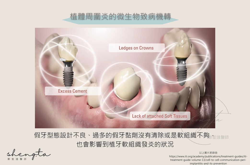 植體周圍炎的微生物致病機轉 - 假牙設計不良、過多的假牙黏劑未清除或軟組織不夠，也會影響到植牙軟組織發炎狀況