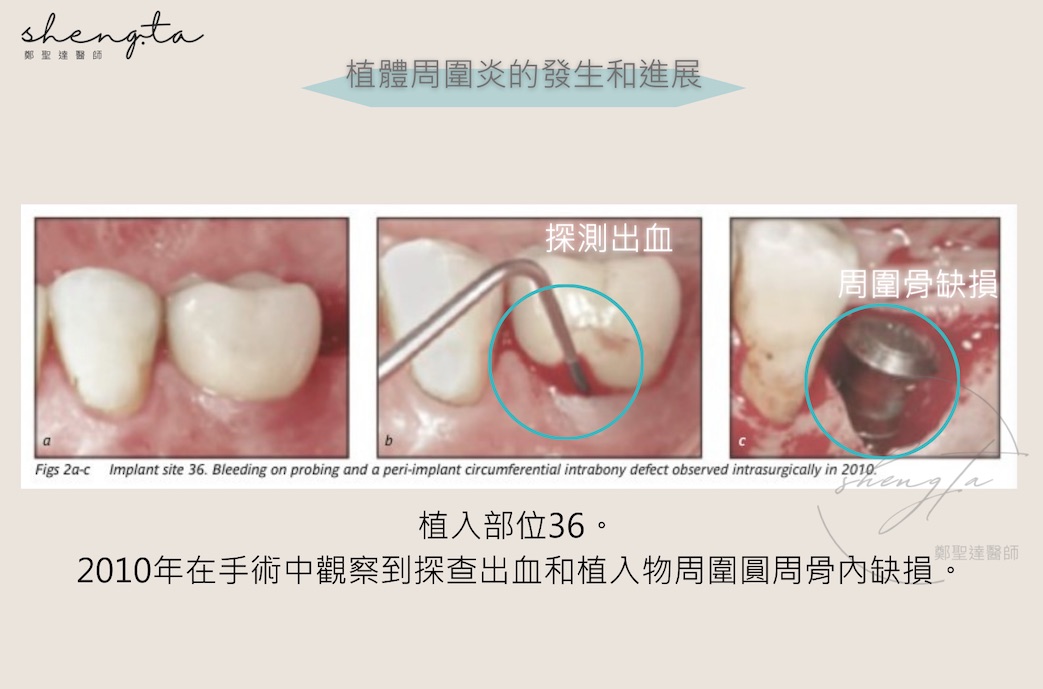 植體周圍炎探測出血與植體周圍骨缺損