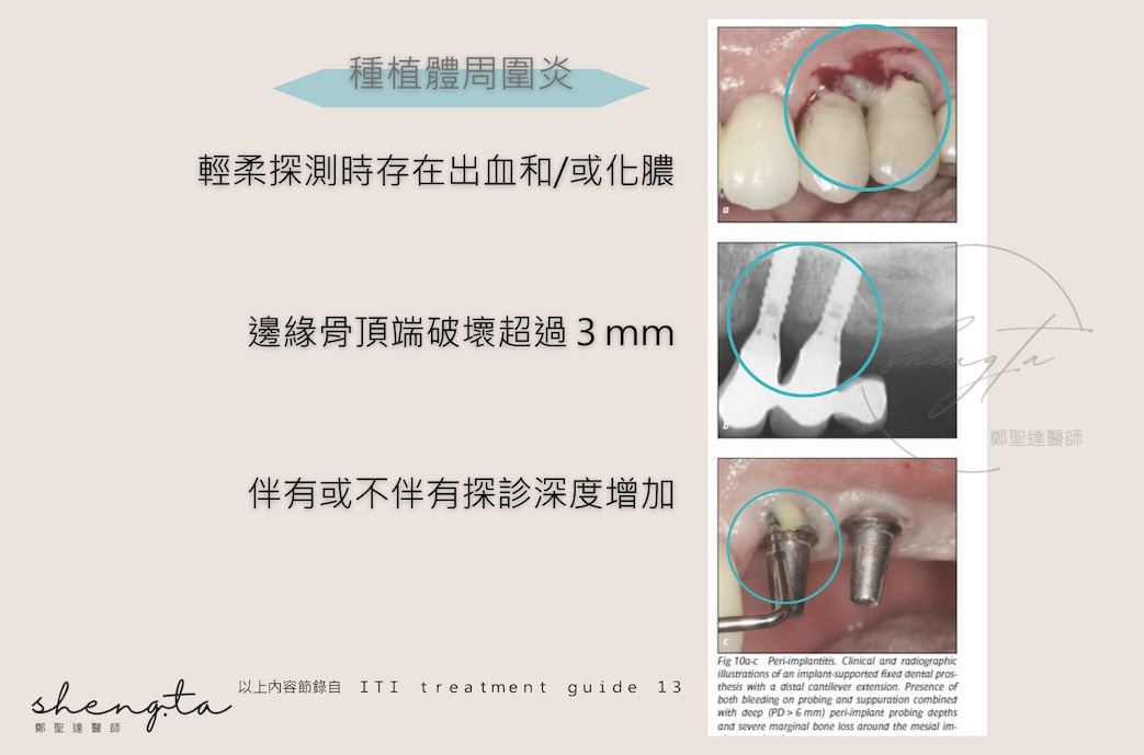 植體周圍炎病例狀態：輕柔探測時存在出血和/或化膿、邊緣骨頂端破壞超過3mm，伴有或不伴有探診深度增加