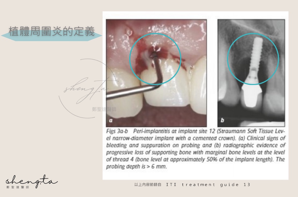 植體周圍炎組織狀態