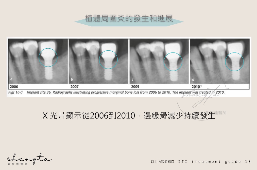 植體周圍炎進展X光片