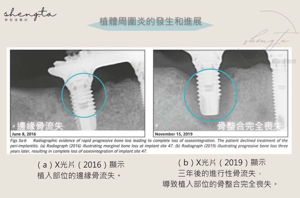 植體周圍炎骨流失進展X光片