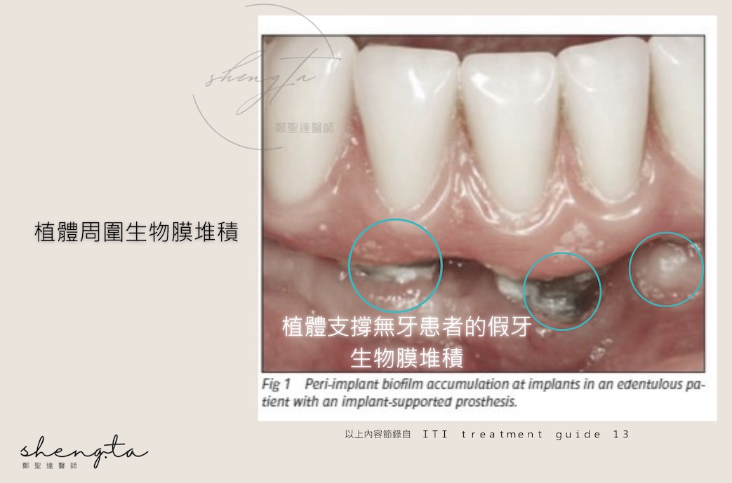 植體周圍炎的微生物致病機轉 - 植體周圍生物膜堆積