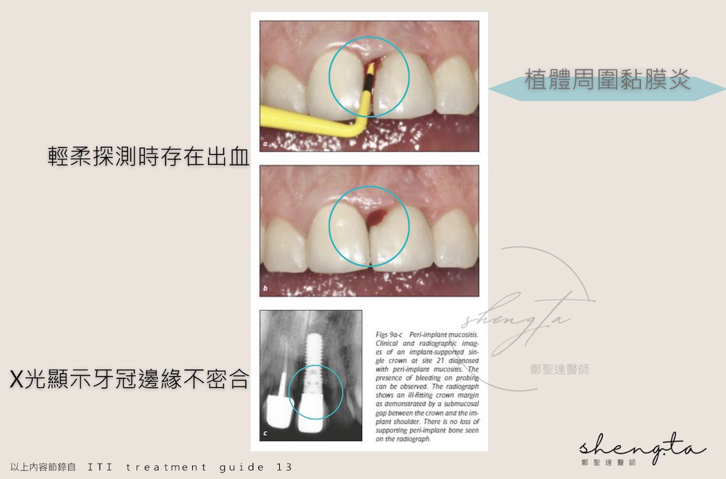 植體周圍黏膜炎病例狀態：輕柔探測時存在出血，X光顯示牙冠邊緣不密合