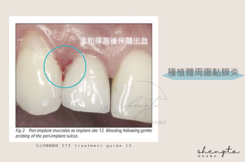 植體周圍黏膜炎組織狀態，溫和探測後伴隨出血