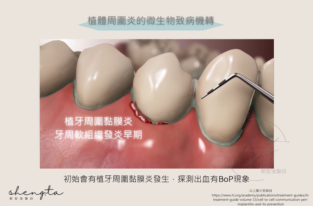 植體周圍炎的微生物致病機轉 - 發生植體周圍黏膜炎與探測出血