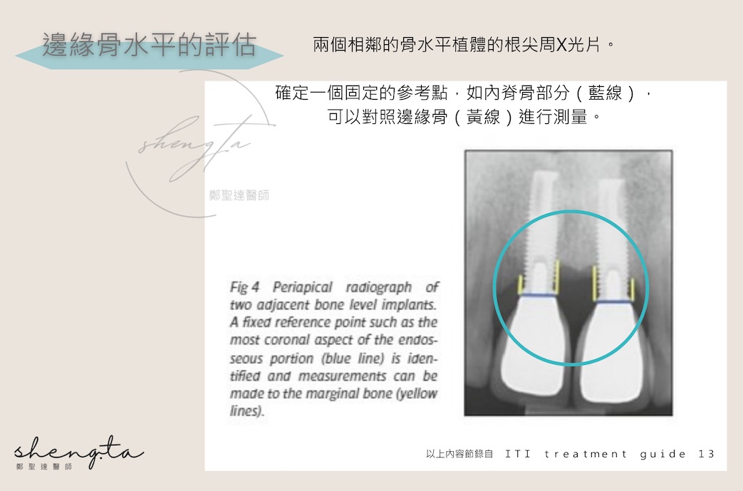 邊緣骨水平的評估