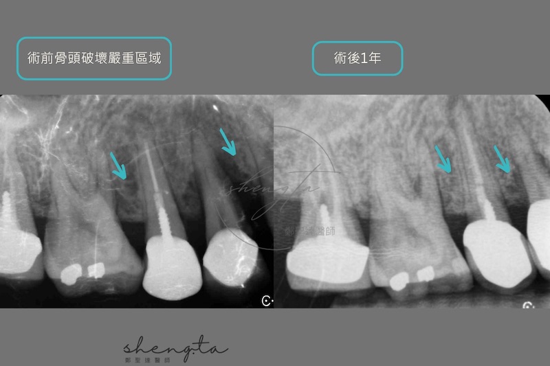右上第一二小臼齒及第一大臼齒牙周再生手術一年後與初診的根尖X光片對比，術前嚴重破壞的牙周組織及齒槽骨已恢復達90%以上