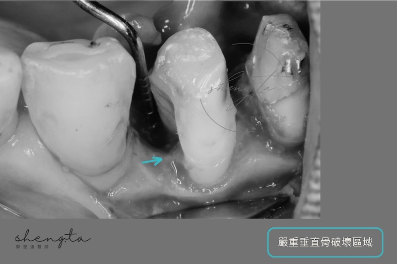 牙周再生手術前，右上第一二小臼齒嚴重垂直骨破壞區域