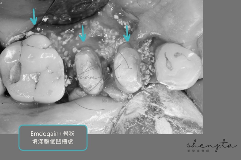 右上第一二小臼齒及第一大臼齒齒槽骨嚴重破壞區，將骨粉及再生因子填滿整個凹槽