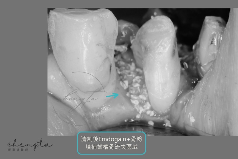 牙周再生手術清創後填入骨粉和再生因子Emdogain，填補齒槽骨流失區域