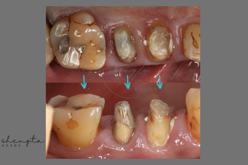 牙周再生手術前，右上第一二小臼齒及第一大臼齒口內照