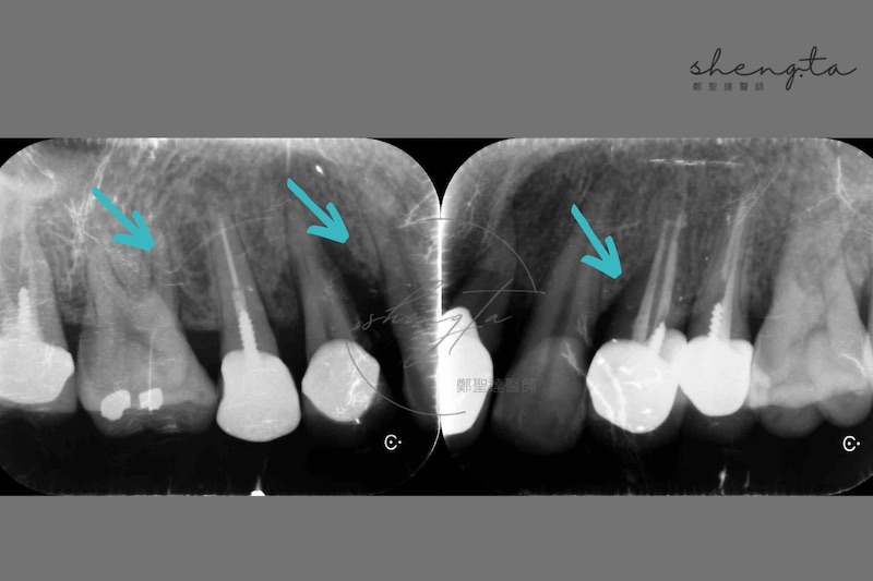 牙周再生手術前，右上第一二小臼齒及第一大臼齒的根尖X光片顯示牙周囊袋破壞較嚴重