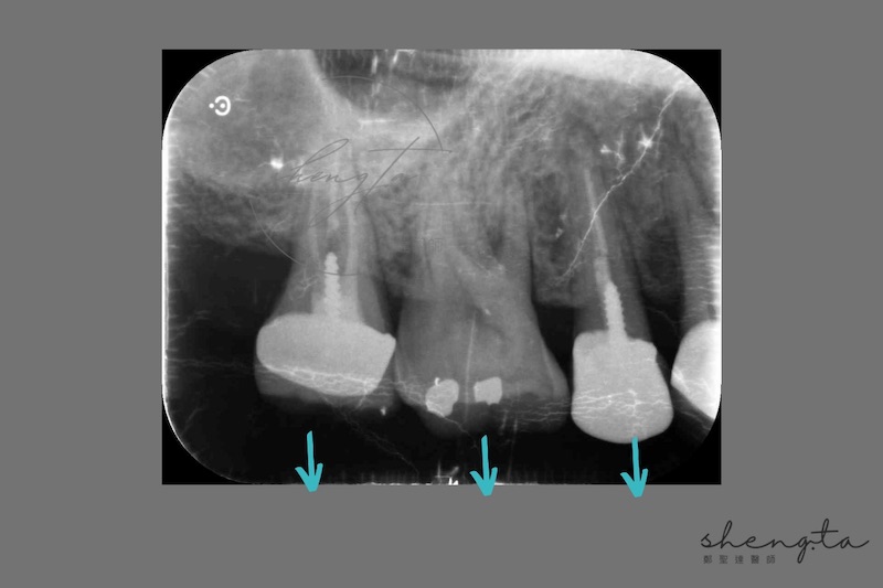 牙周再生手術前，右上第一二小臼齒及第一大臼齒的根尖X光片