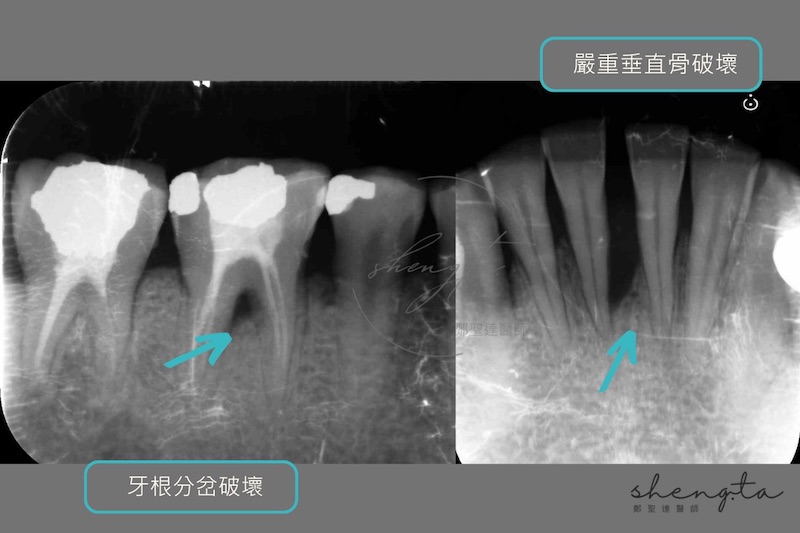 牙周再生手術前，右下臼齒與正中門牙的根尖X光片顯示牙周破壞到牙根分岔處，以及嚴重垂直骨破壞