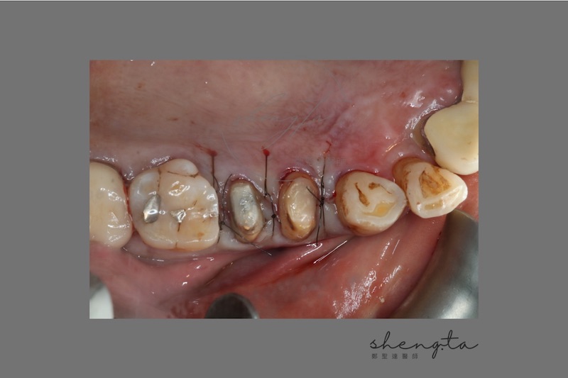 牙周再生手術後，縫合手術區域