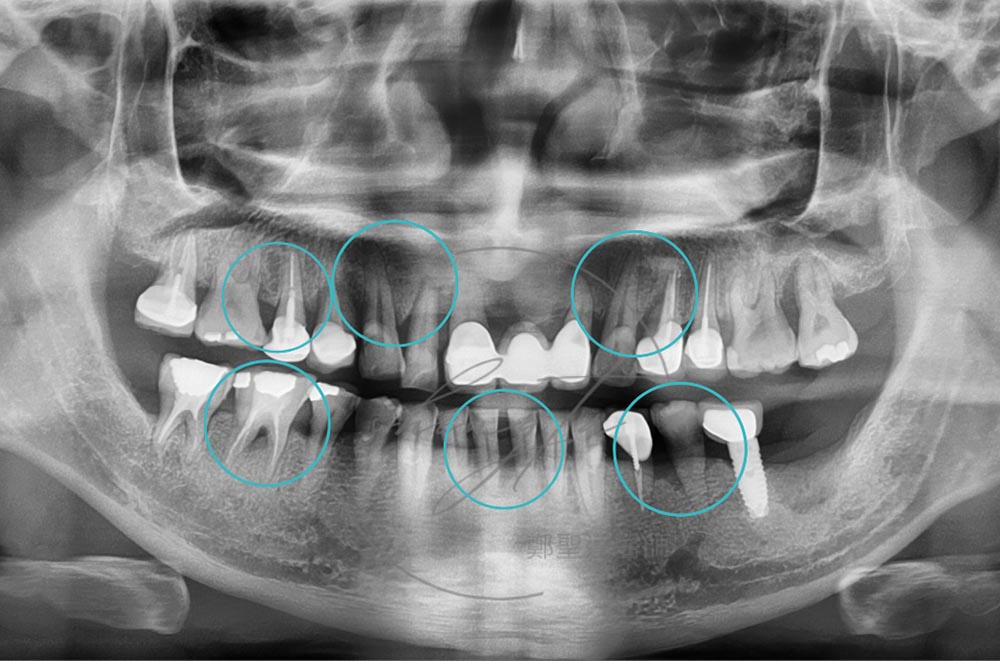 重度牙周病-水雷射-微創牙周治療-牙周再生手術-推薦-鄭聖達醫師