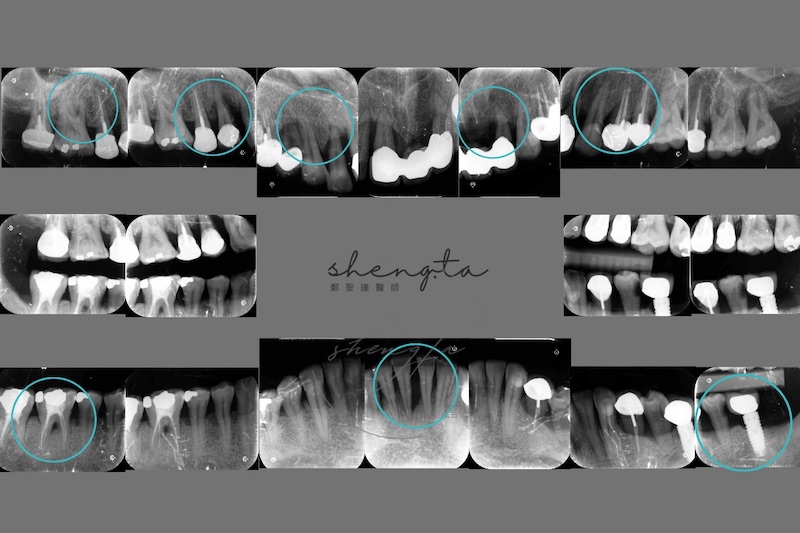 中重度牙周病治療前的全口根尖X光片，多顆牙齒在治療後需要評估手術