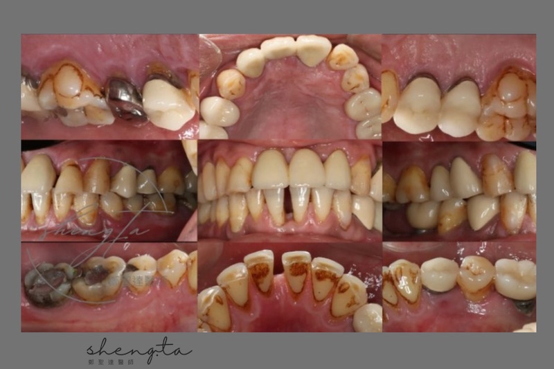 中重度牙周病治療前的全口牙齒照片，可見許多煙垢，以及不密合的牙套堆積牙菌斑