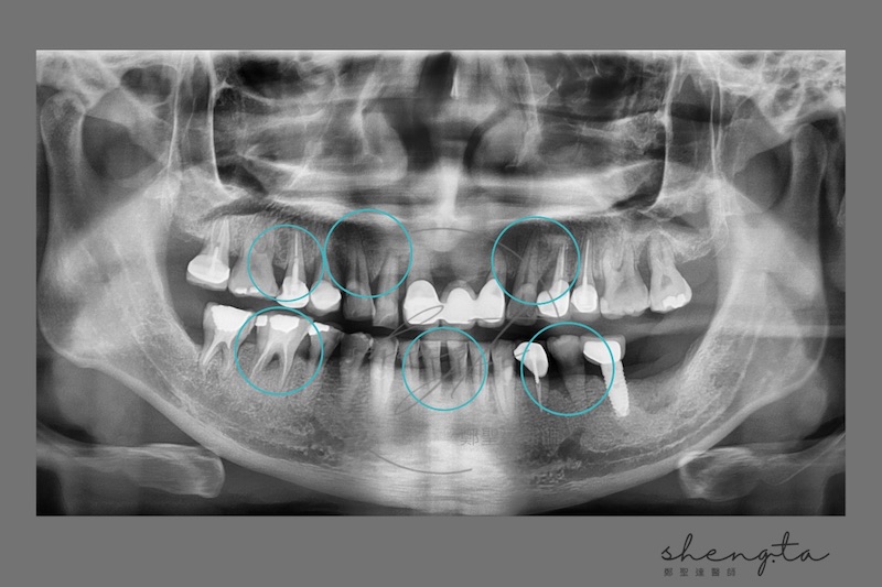 中重度牙周病治療前的環口X光片，口內有多處牙周嚴重破壞