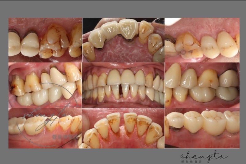 中重度牙周病治療後的全口牙齒照片，已大幅改善煙垢、牙菌斑