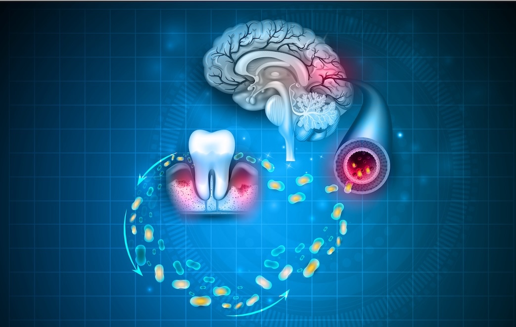 牙周與口腔病菌透過血液進入大腦示意圖
