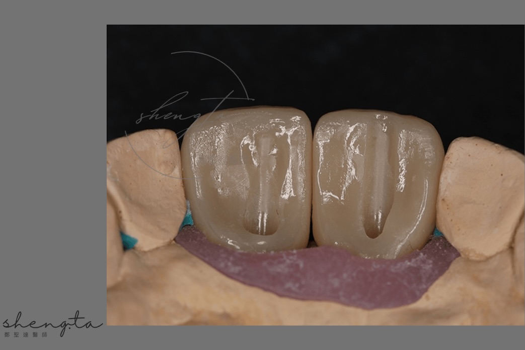 數位植牙過程 - 假牙與顎側面維修開孔