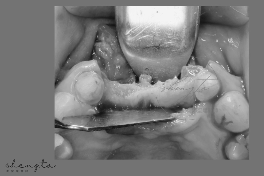 植牙補骨前，有大範圍水平骨缺損