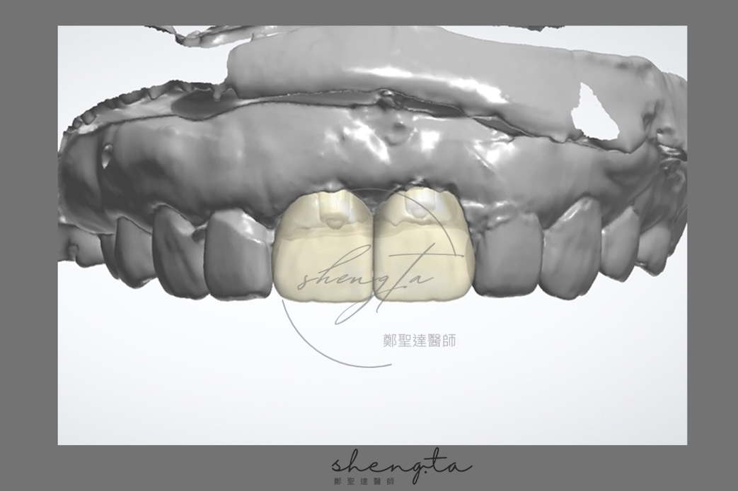 數位植牙過程 - 使用數位軟體設計支台齒和植牙