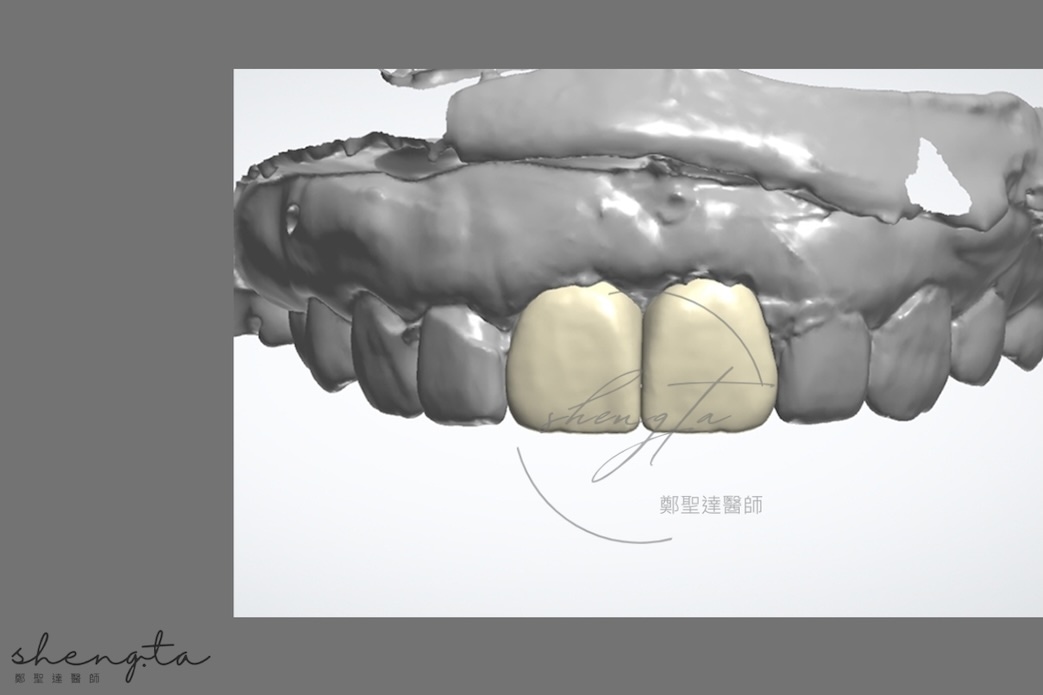 數位植牙過程 - 使用數位軟體設計未來植牙假牙外觀