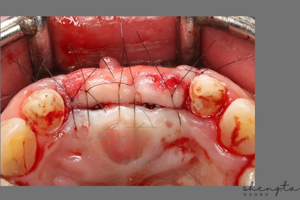 數位植牙過程 - 傷口閉合處，植體位置約有1毫米的輕微開口