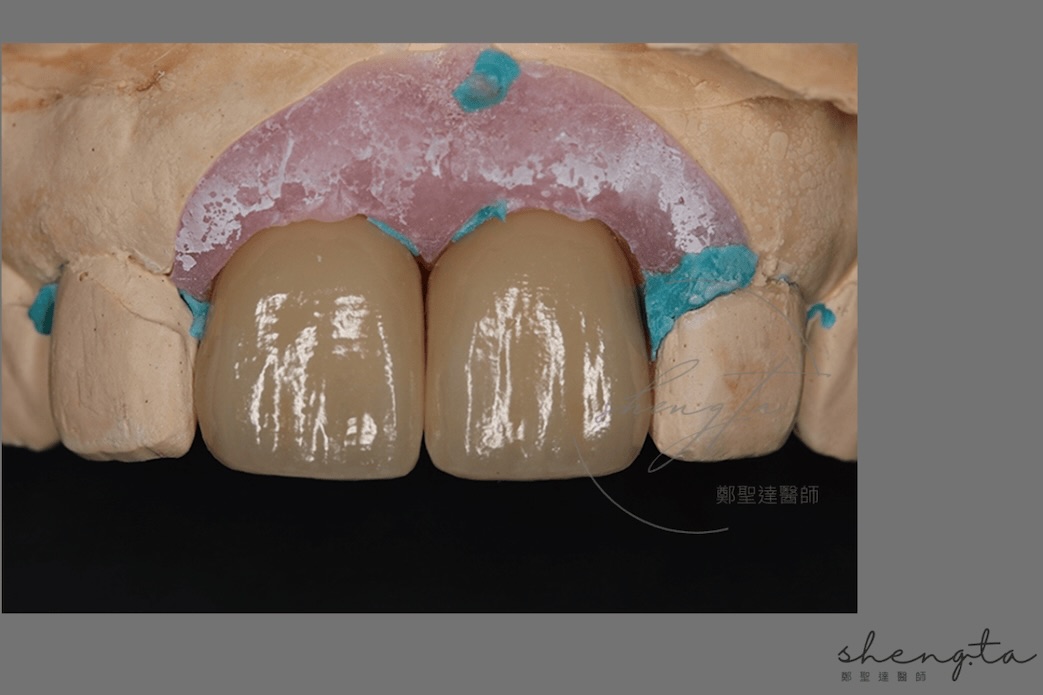 數位植牙過程 - 植牙全瓷冠假牙模型